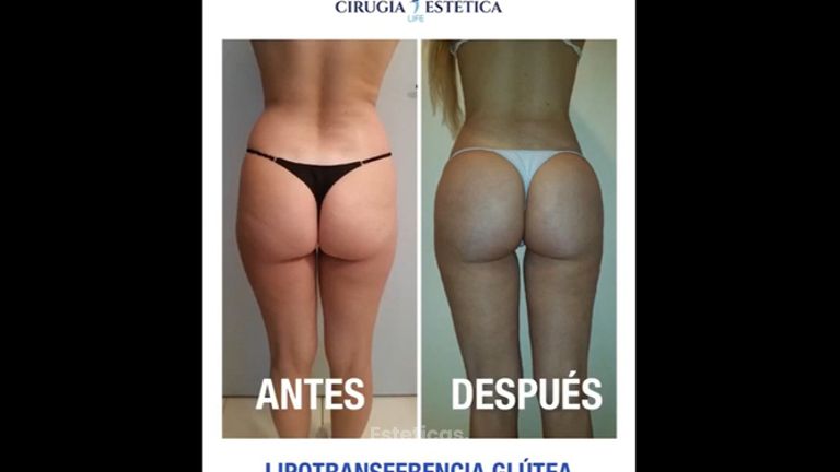 Lipotransferencia glútea