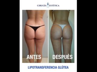 Lipotransferencia glútea