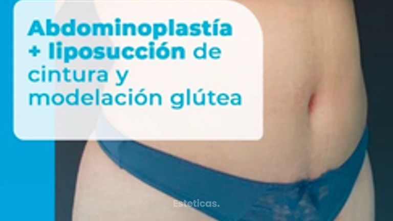 Abdominoplastia - Dr. Lucas Sánchez