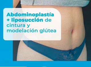 Abdominoplastia - Dr. Lucas Sánchez