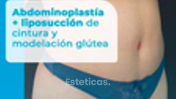 Abdominoplastia - Dr. Lucas Sánchez