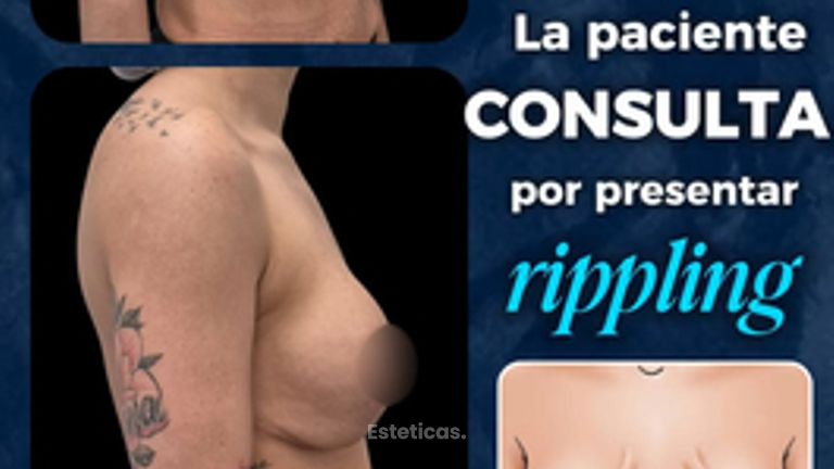Recambio de implantes - Dr. Damián Wengrowicz