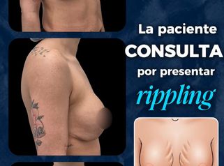 Recambio de implantes - Dr. Damián Wengrowicz