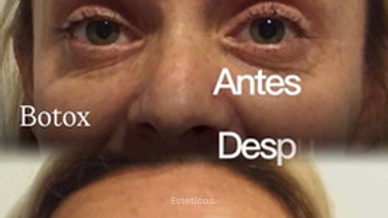 Botox - Dra. María de la Paz Vélez