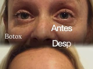Botox - Dra. María de la Paz Vélez