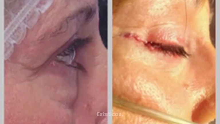 Blefaroplastia - Dr. Walter Gabriel Huck - Centro Médico Alvear