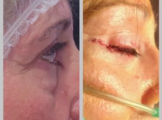 Blefaroplastia - Dr. Walter Gabriel Huck - Centro Médico Alvear