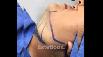 Liposucción de papada - Dr. Franco Gomez