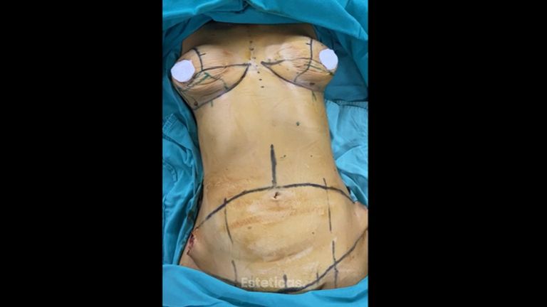 Lipoescultura - Dr. Emmanuel Manavela Chiapero