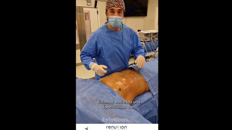 Lipoescultura - Dr. Damián Galeazzo y Equipo