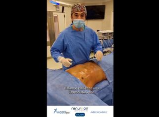 Lipoescultura - Dr. Damián Galeazzo y Equipo