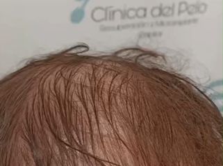 Implante capilar - Dr. Damián Galeazzo y Equipo