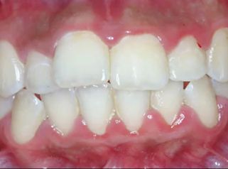 Ortodoncia invisible - Dental Advance
