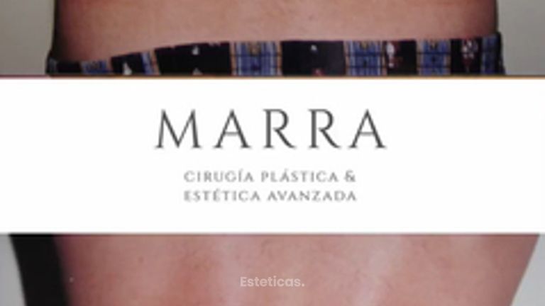 Liposucción - Clínica Marra