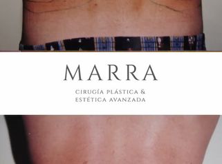 Liposucción - Clínica Marra