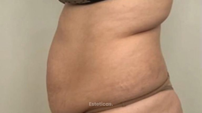 Abdominoplastia - Dr. Emmanuel Manavela Chiapero