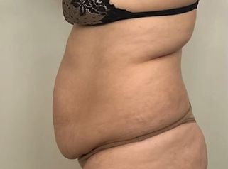 Abdominoplastia - Dr. Emmanuel Manavela Chiapero