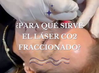 Láser CO2 - Dr. Agustín Matia