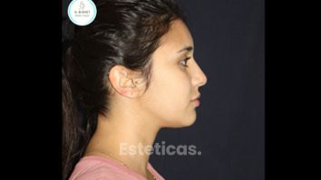 Bichectomia + Lipo Láser 3D de cuello - Dr. Williams Erik Bukret