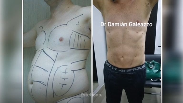 Marcación Abdominal