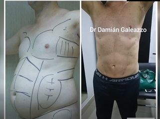 Marcación Abdominal