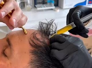 Plasma Rico en Plaquetas Capilar - Dra. Maria Victoria Rodriguez