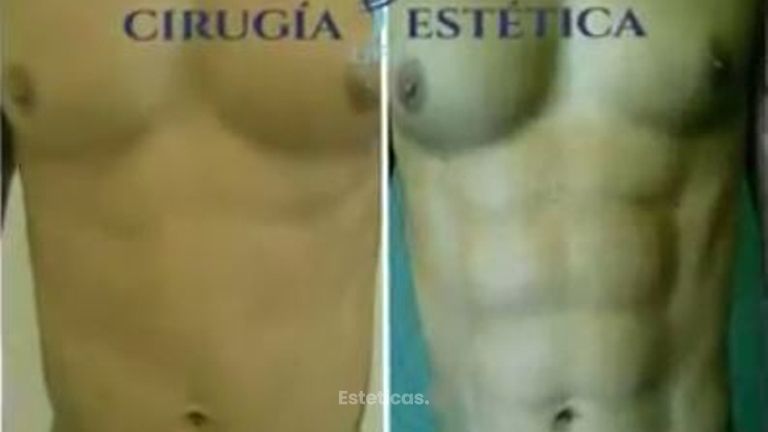 Lipoescultura HD.