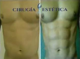 Lipoescultura HD.