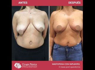 Mastopexia - Dr. Emmanuel Manavela Chiapero