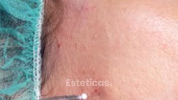 ¿Sabes lo que son los hilos tensores? - Dra. Jimena D. Frasso