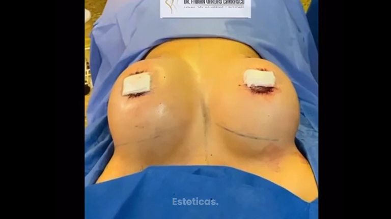 Aumento de mamas - Dr. Fabian Vargas Carrasco