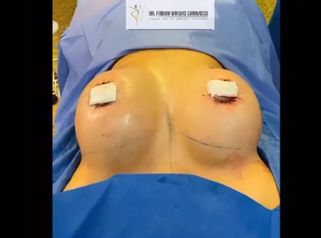 Aumento de mamas - Dr. Fabian Vargas Carrasco