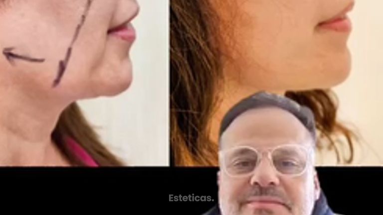 Lifting Facial - Dr. Matias Llabres