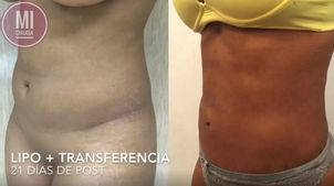 Experiencia liposucción Experiencia liposucción