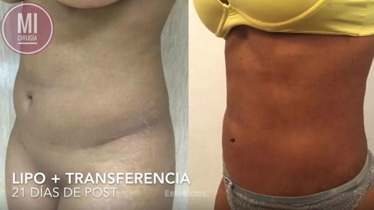 MI LIPO CON MARCACIÓN Y TRANSFERENCIA A GLÚTEOS