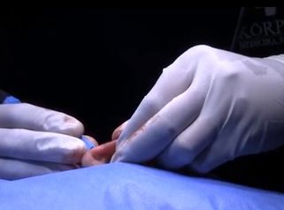 Otoplastia 