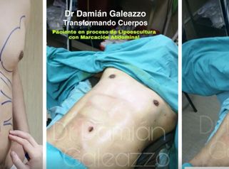 Proceso de Lipoescultura con Marcación Abdominal