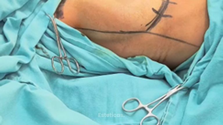 Aumento Mamas - Dr. Damián Wengrowicz