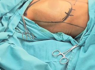 Aumento Mamas - Dr. Damián Wengrowicz