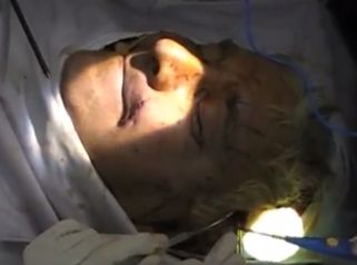 Así se hace una reanimación de parálisis facial