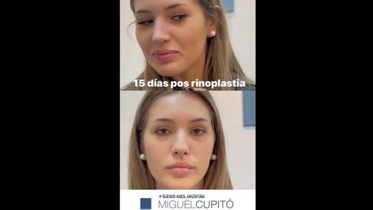Rinoplastia - Dr. Miguel Ángel Cupito