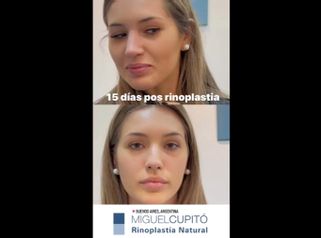 Rinoplastia - Dr. Miguel Ángel Cupito