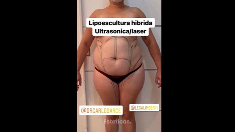 Abdominoplastia - Dr. Carlos Arce