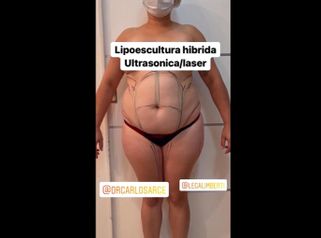 Abdominoplastia - Dr. Carlos Arce