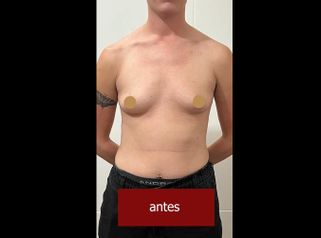 Ginecomastia - Dr. Emmanuel Manavela Chiapero