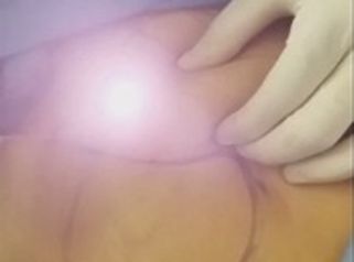 Mini Lipoescultura Lasér o MELA