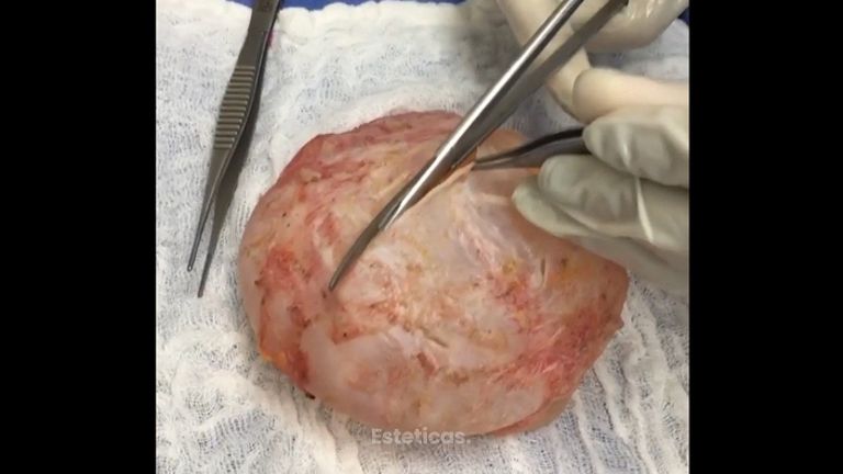 Que sucede cuando tenemos una contractura capsular en las mamas?