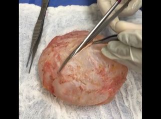 Que sucede cuando tenemos una contractura capsular en las mamas?