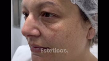 Blefaroplastia - Dr. Gustavo Godoy