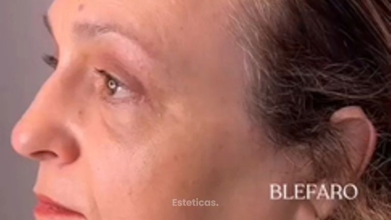 Blefaroplastia - Dra. Mariana Bouvier